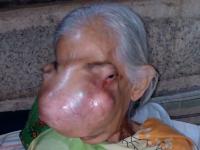 У жительницы Филиппин опухоль в полости носа разрослась настолько, что раздробила передние кости черепа (фото, видео)