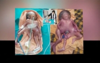 В Индии родилась девочка, у которой 8 конечностей (видео)