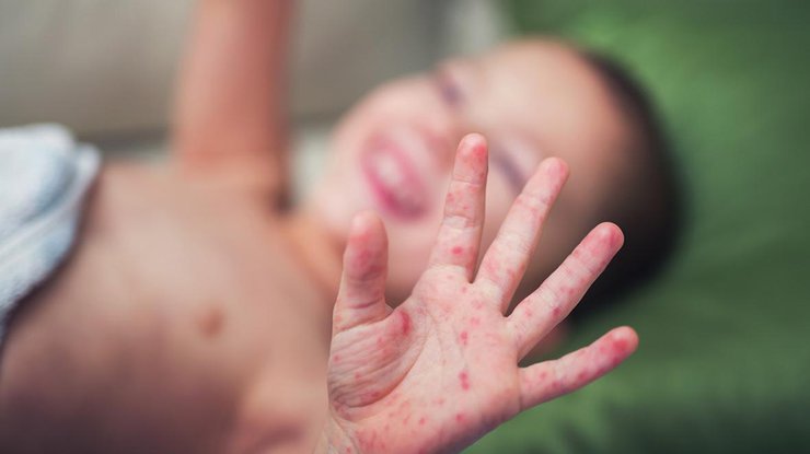 За неделю сотни детей заболели корью во Львовской области