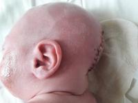 Малыш появился на свет с грыжей головного мозга, которая была больше... его головы (фото)
